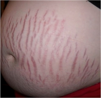 Stretch-Marks